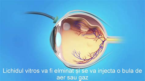 Cat Dureaza Operatia De Dezlipire De Retina