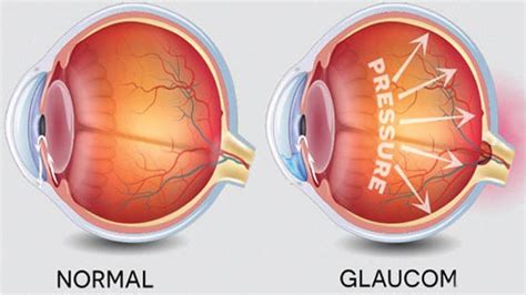 Ce Este Glaucomul