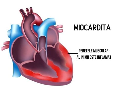 Ce Este Miocardita