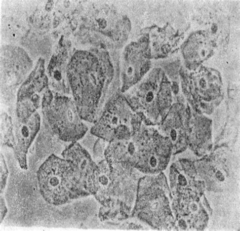 Celule Epiteliale Plate Rare In Urina Ce Inseamna