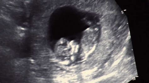 La Cate Saptamani Se Vede Embrionul In Sacul Gestational